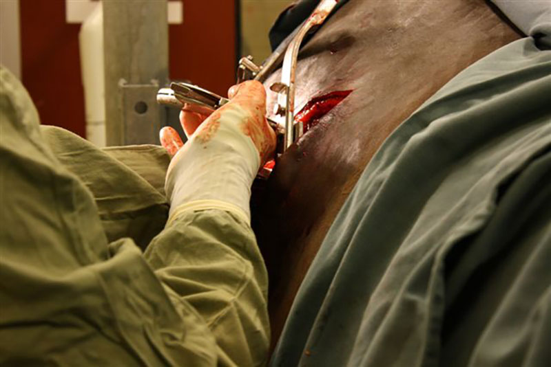 Operation-laparoskopi-aggstockstumor-(22)