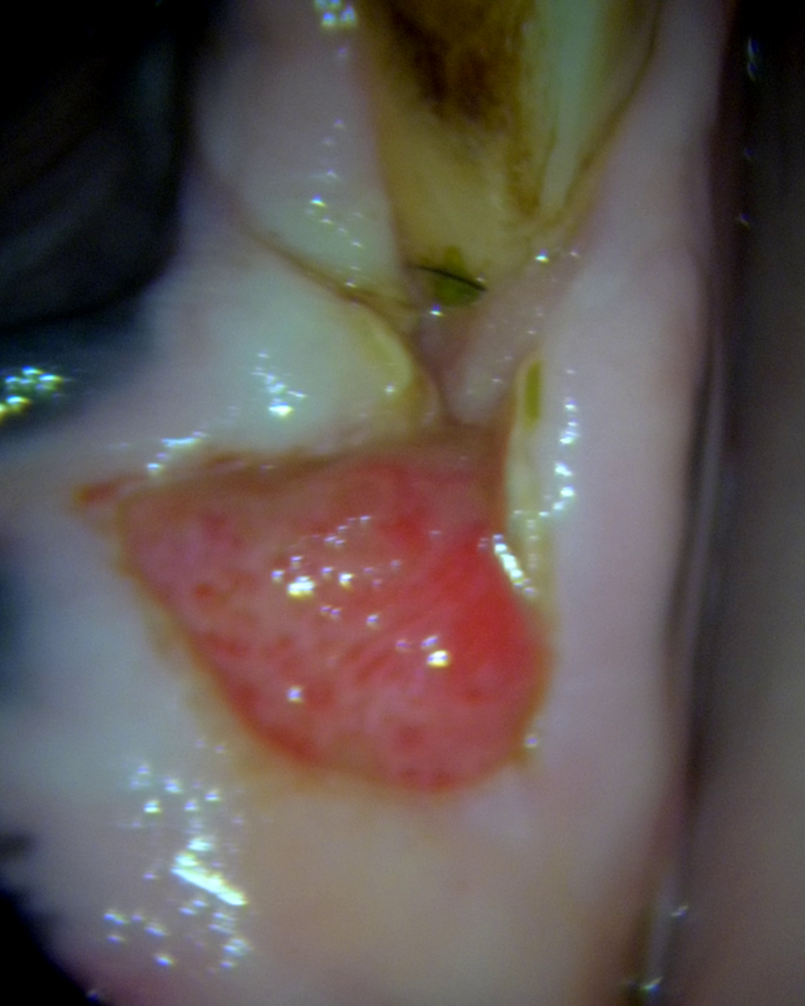 Sårskada Efter Bett